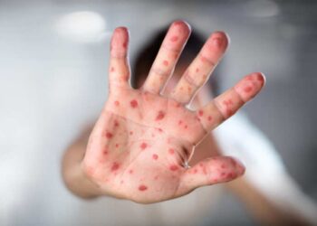 Salud confirma 11 casos importados de sarampión en el país