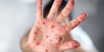 Salud confirma 11 casos importados de sarampión en el país